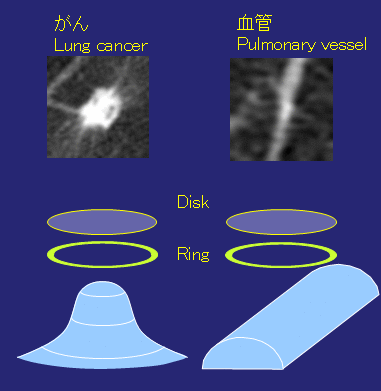 Fig.2 DiskフィルタとRingフィル
		       タによる癌陰影の検出．